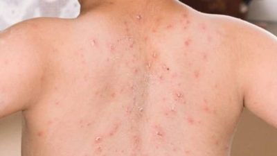 KLB Campak Sumenep Meningkat, Pemprov Jatim Gencarkan ORI Vaksinasi MR.